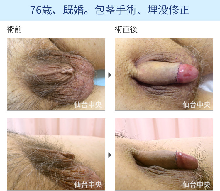 76歳、既婚。包茎手術、埋没修正