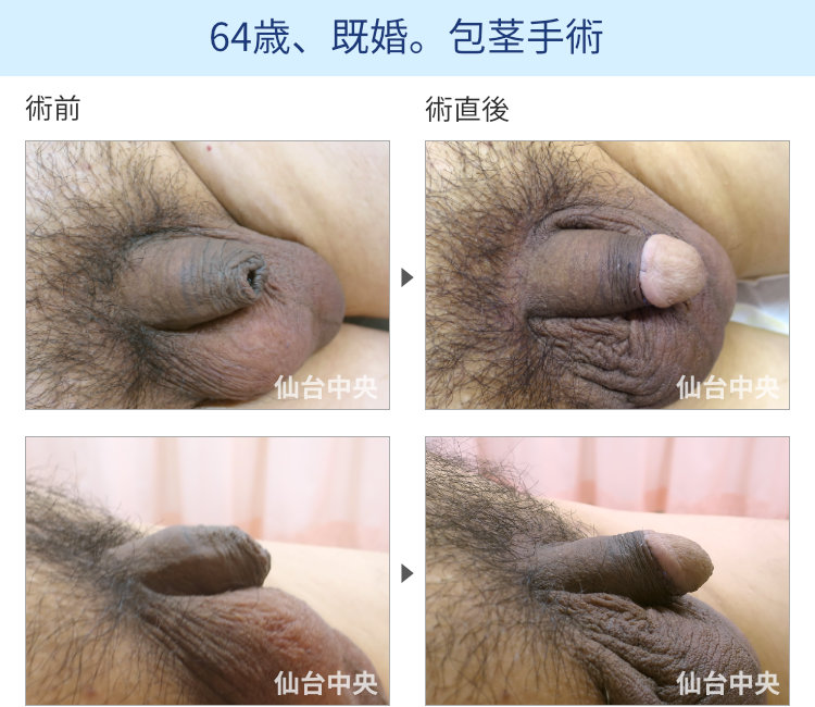 64歳、既婚。包茎手術