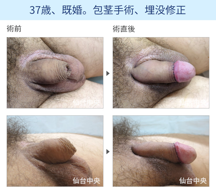 37歳、既婚。包茎手術、埋没修正