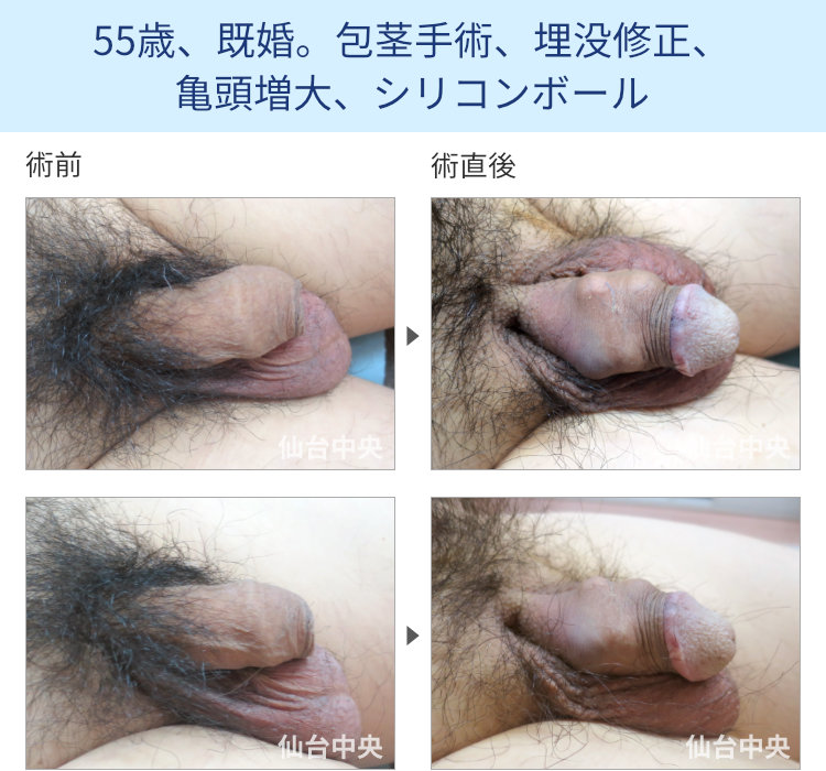 55歳、既婚。包茎手術、埋没修正、亀頭増大、シリコンボール