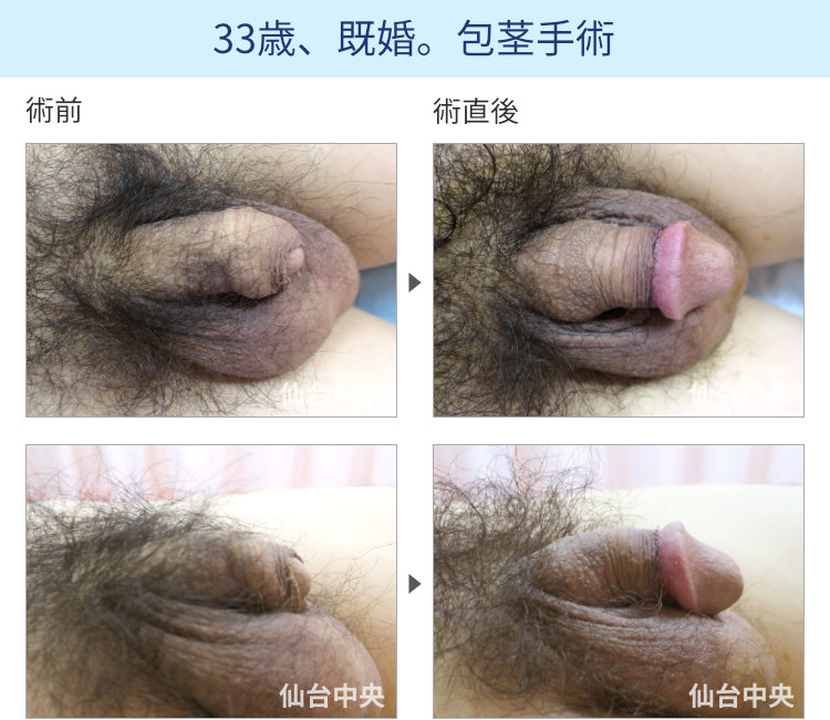 33歳、既婚。包茎手術