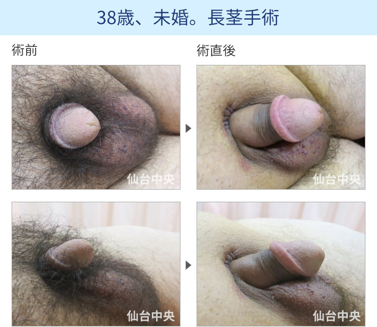 38歳、未婚。長茎手術