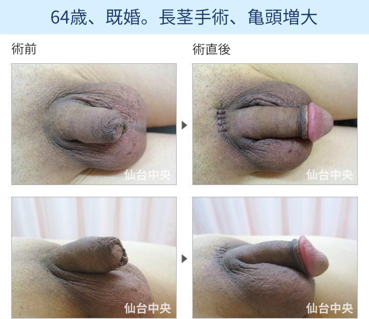 64歳、既婚。長茎手術、亀頭増大