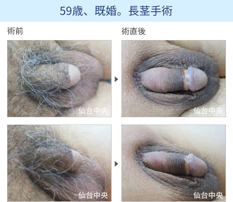 59歳、既婚。長茎手術