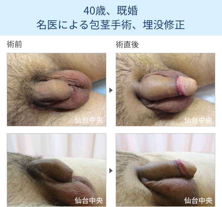 40歳、既婚。名医による包茎手術、埋没修正