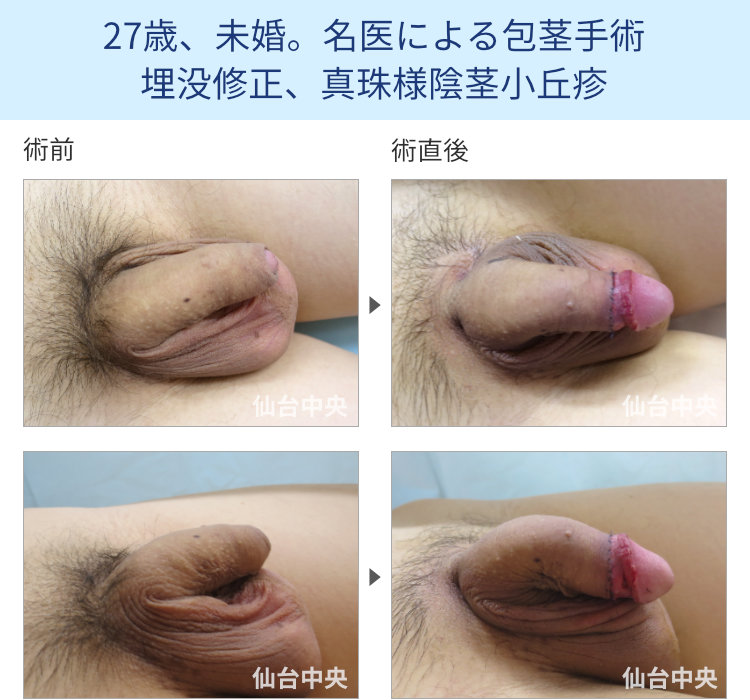 27歳、未婚。名医による包茎手術、埋没修正、真珠様陰茎小丘疹