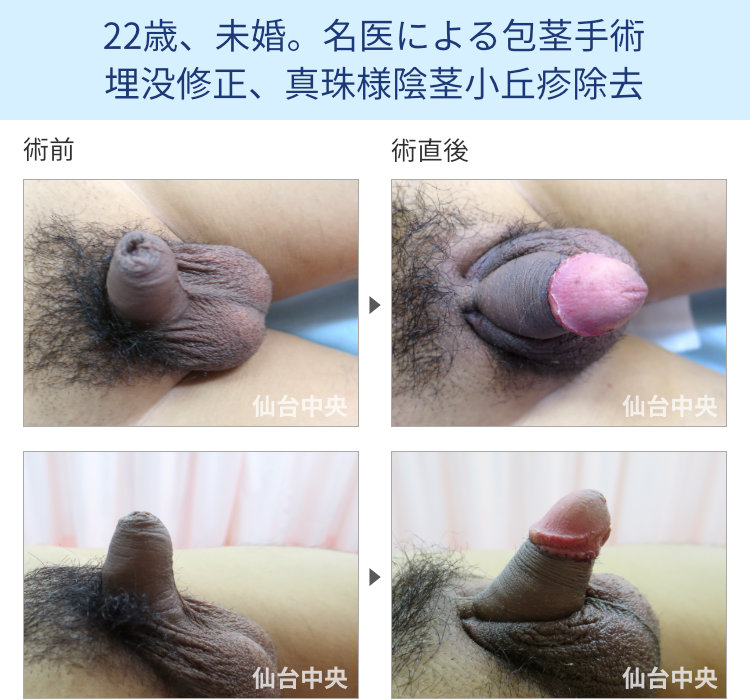 22歳、未婚。名医による包茎手術、埋没修正、真珠様陰茎小丘疹除去
