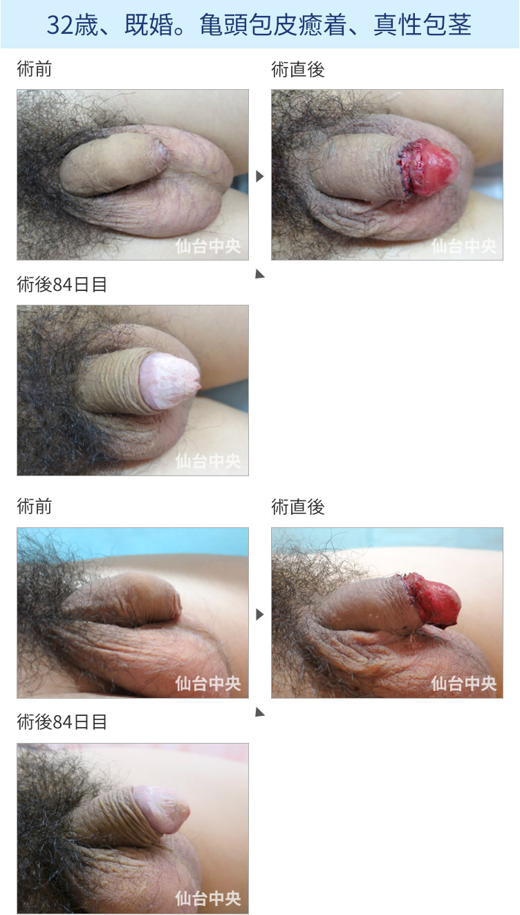 32歳、既婚。亀頭包皮癒着、真性包茎