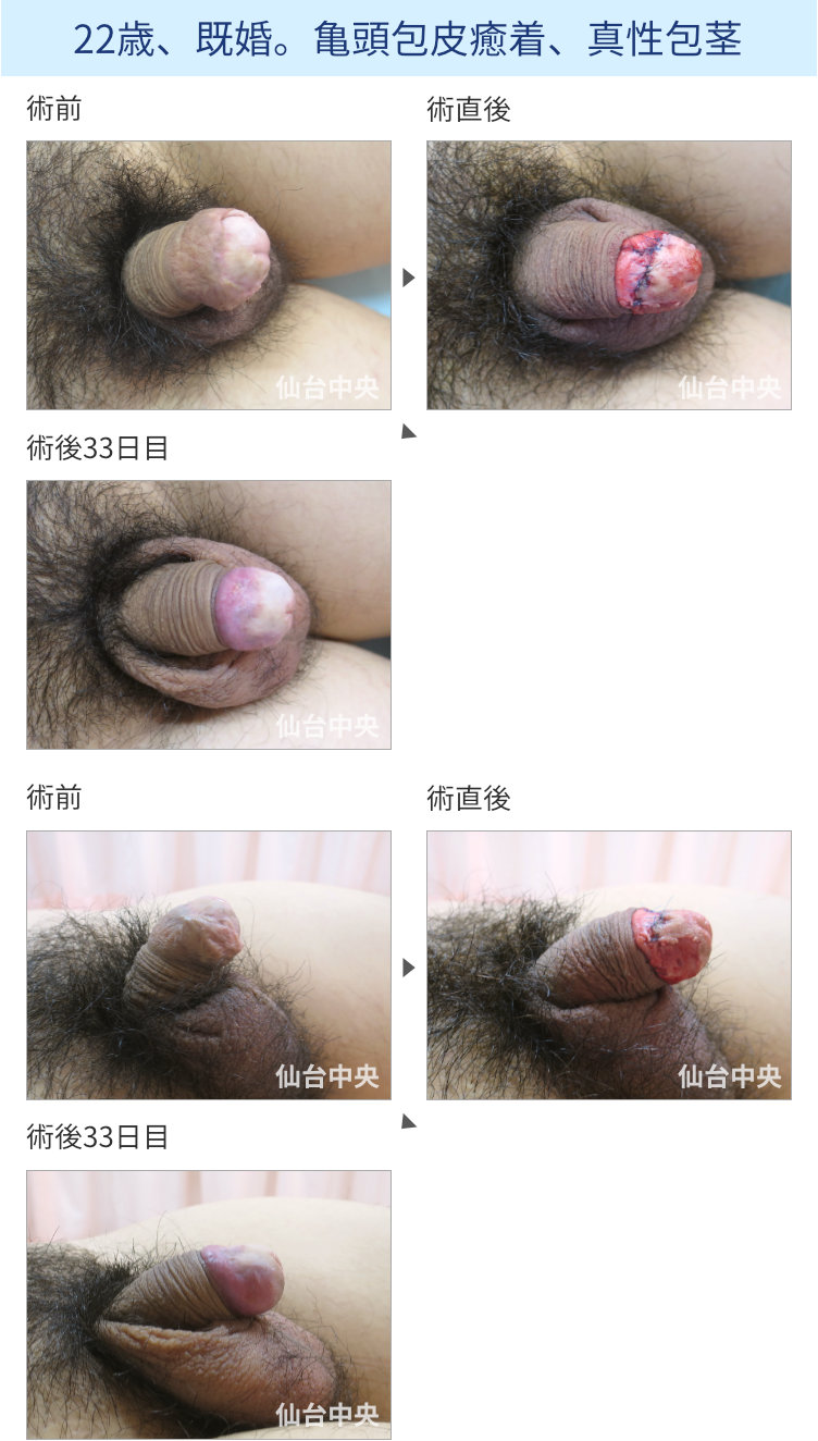 22歳、既婚。亀頭包皮癒着、真性包茎