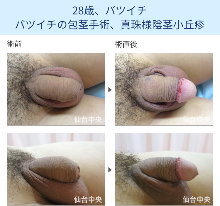 28歳、バツイチ。包茎手術、真珠様陰茎小丘疹