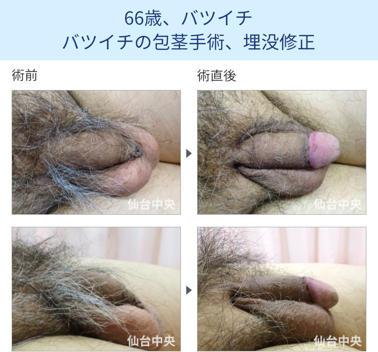 66歳、バツイチ。バツイチの包茎手術、埋没修正