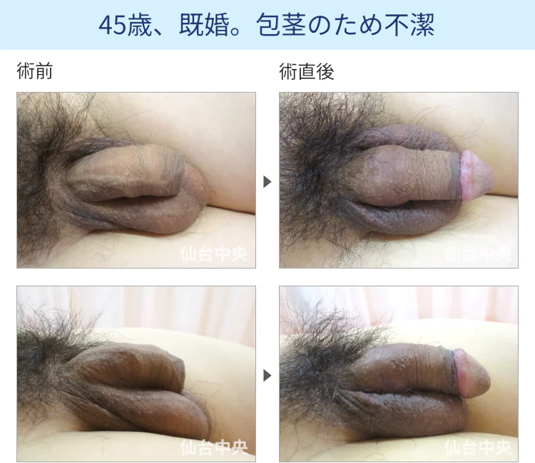 45歳、既婚。包茎のため不潔の症例写真