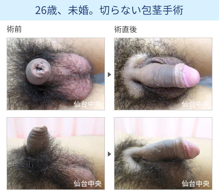 26歳、未婚。切らない包茎手術の症例写真