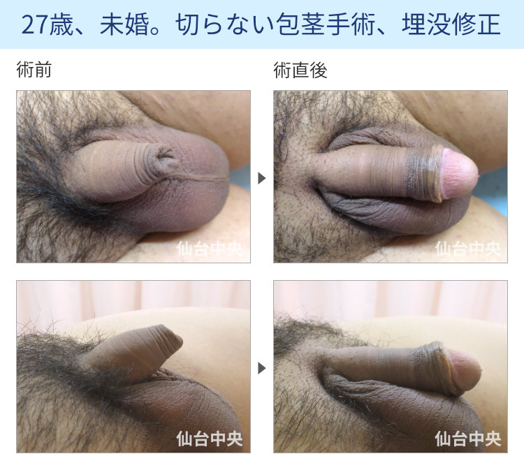 27歳、未婚。切らない包茎手術、埋没修正の症例写真