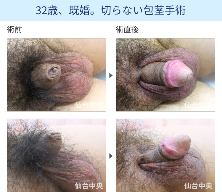 32歳、既婚。切らない包茎手術の症例写真