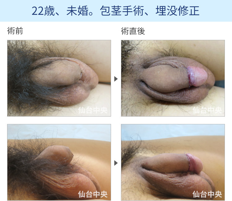 22歳、未婚。包茎手術、埋没修正