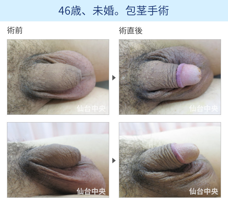 46歳、未婚。包茎手術
