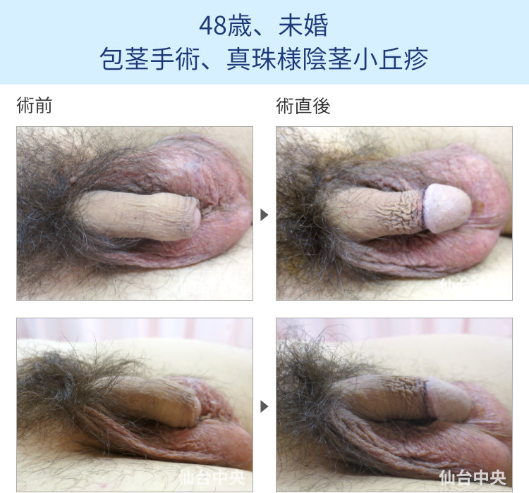 48歳、未婚。包茎手術、真珠様陰茎小丘疹