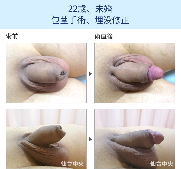 22歳、未婚。包茎手術、埋没修正
