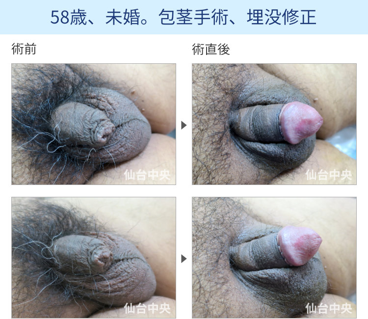 58歳、未婚。包茎手術、埋没修正