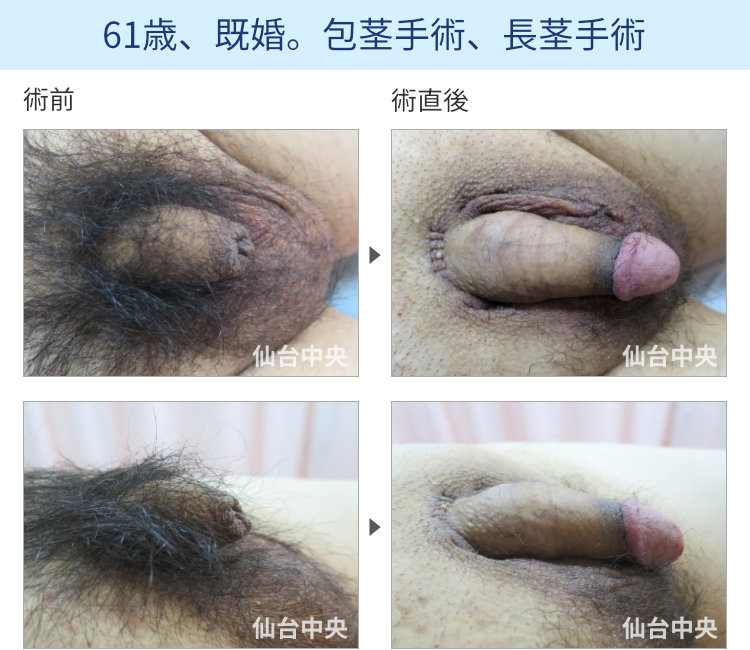 61歳、既婚。包茎手術、長茎手術
