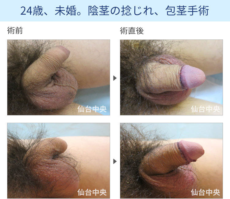 左に曲がった陰茎手術症例写真、術前・術直後の比較 - 20代男性
