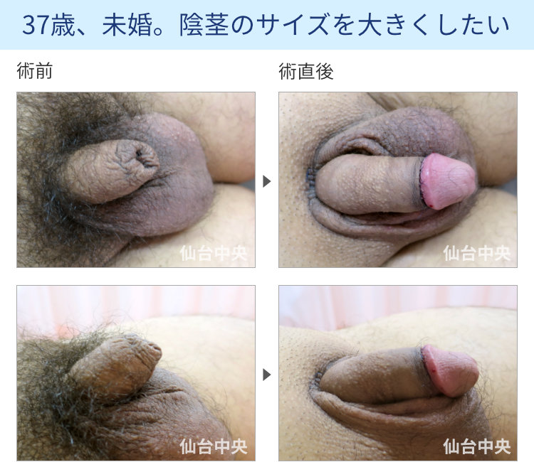 陰茎増大、包茎同時手術の症例写真、術前・術直後の比較 - 30代男性