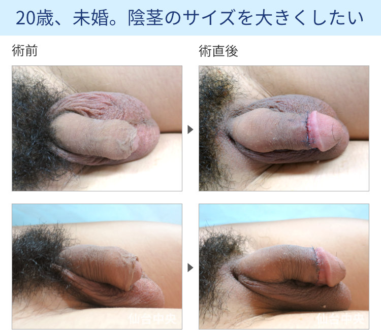 陰茎増大、包茎同時手術の症例写真、術前・術直後の比較 - 50代男性