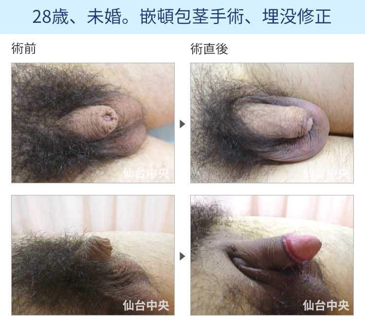 28歳、未婚。嵌頓包茎手術、埋没修正