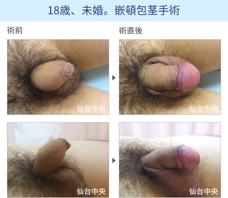 18歳、未婚。嵌頓包茎手術