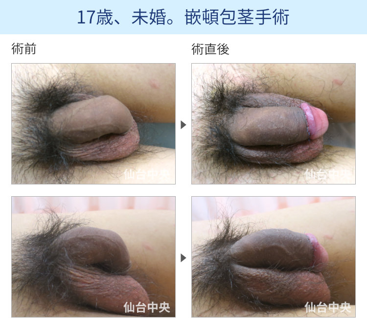 17歳、未婚。嵌頓包茎手術