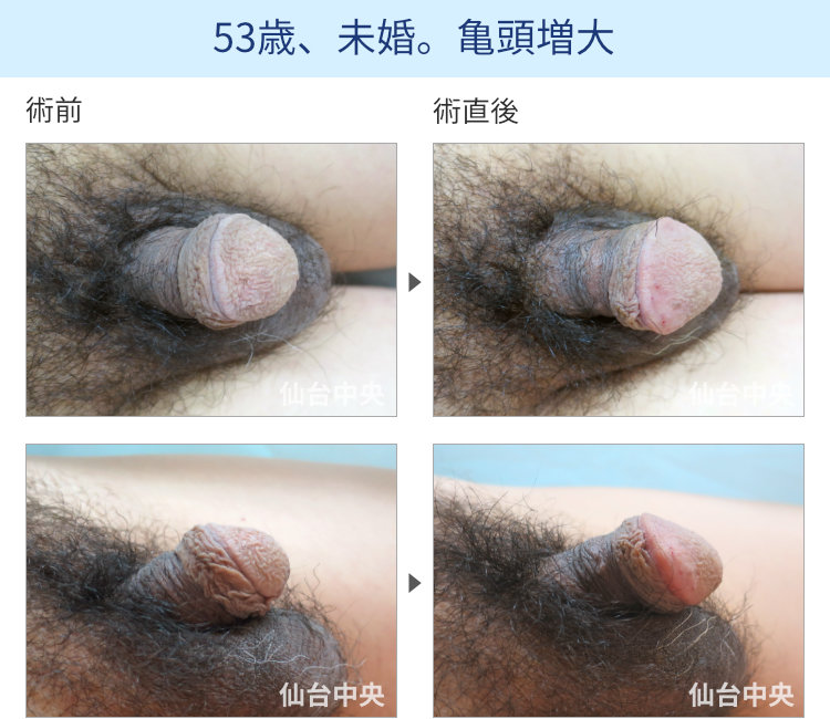53歳、未婚。亀頭増大