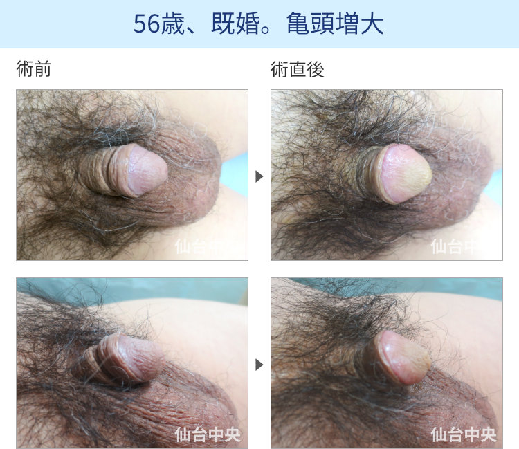 56歳、既婚。亀頭増大