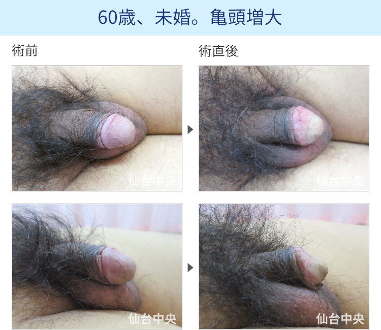 60歳、未婚。亀頭増大
