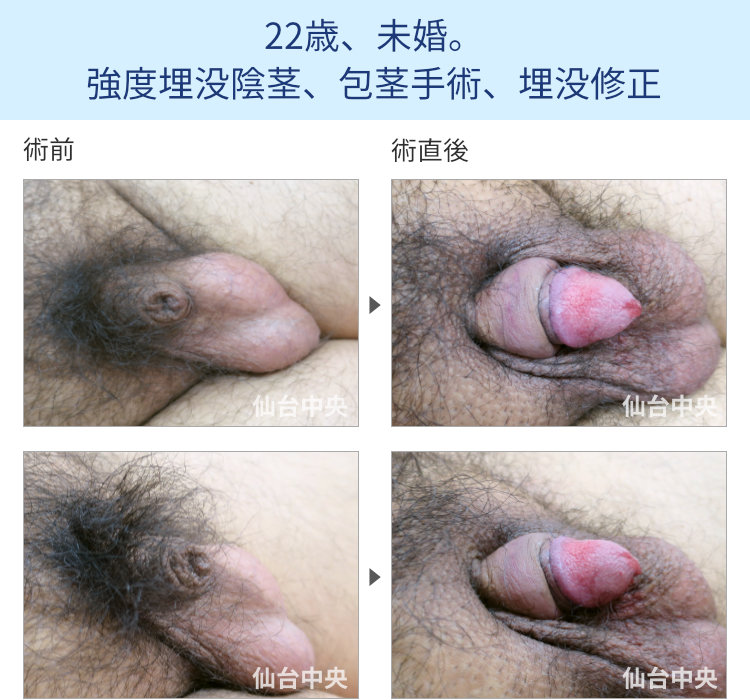 22歳、未婚。強度埋没陰茎、包茎手術、埋没修正