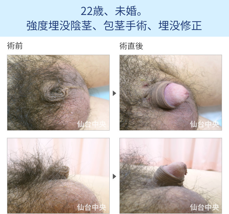 44歳、既婚。強度埋没陰茎、包茎手術、埋没修正