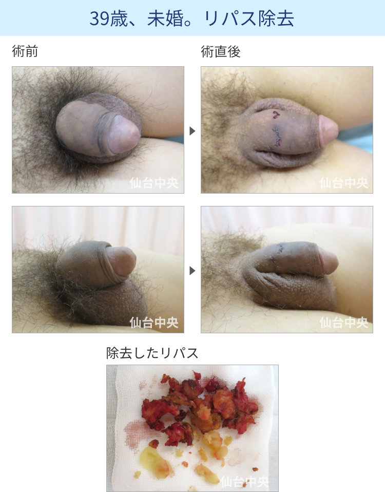 39歳、未婚。リパス除去
