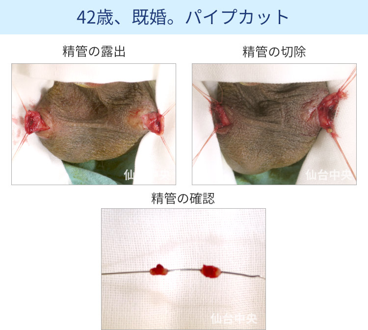 パイプカット手術の切開、露出、切除経過写真 - 40代男性