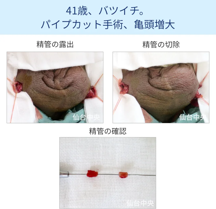 パイプカット手術の切開、露出、切除経過写真 - 40代男性