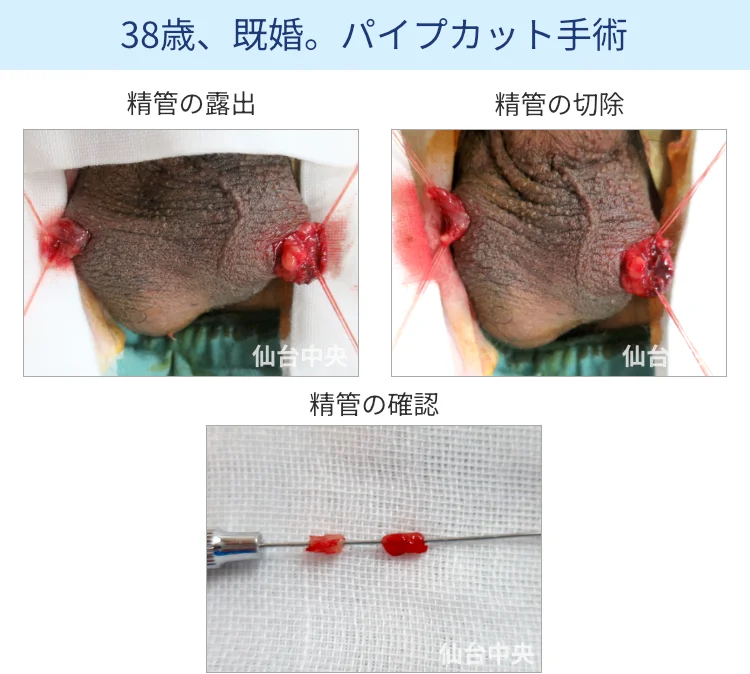 パイプカット手術の切開、露出、切除経過写真 - 30代男性