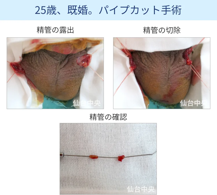 パイプカット手術の切開、露出、切除経過写真 - 20代男性