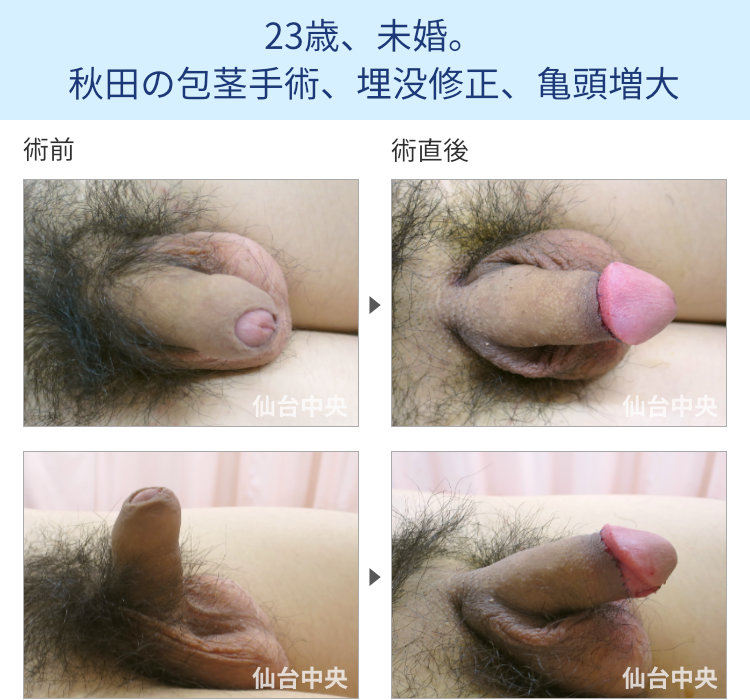 23歳、未婚。秋田の包茎手術、埋没修正、亀頭増大