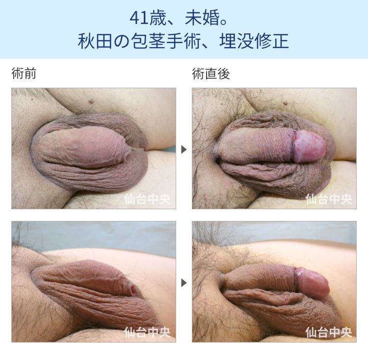 41歳、未婚。秋田の包茎手術、埋没修正