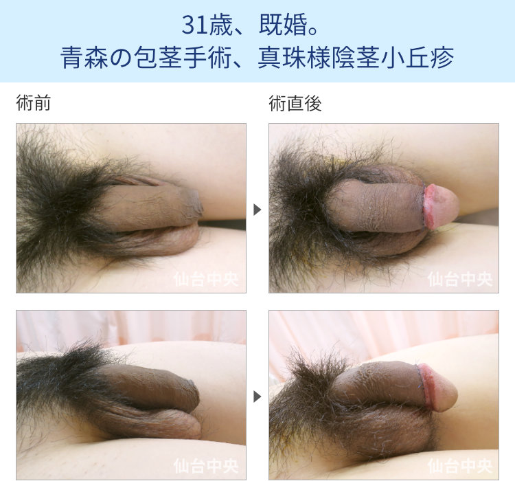 31歳、既婚。青森の包茎手術、真珠様陰茎小丘疹