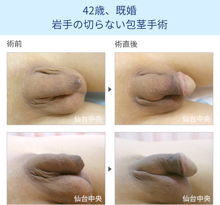 42歳、既婚。岩手の切らない包茎手術