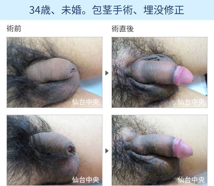 34歳、未婚。包茎手術、埋没修正