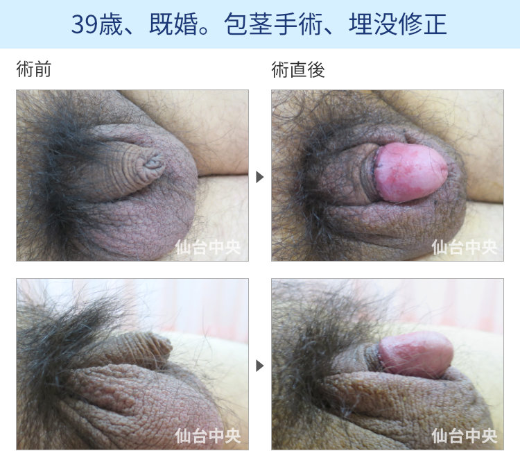39歳、既婚。包茎手術、埋没修正