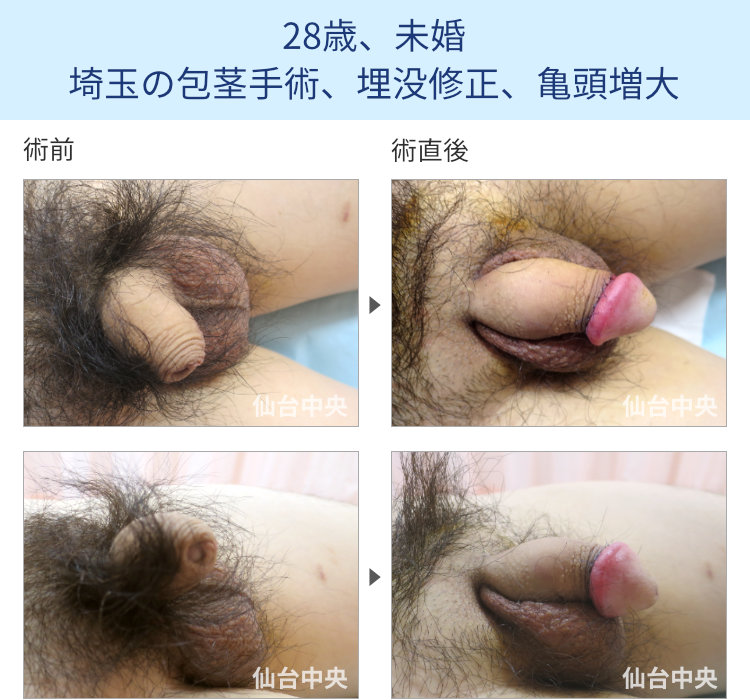 28歳、未婚。埼玉の包茎手術、埋没修正、亀頭増大