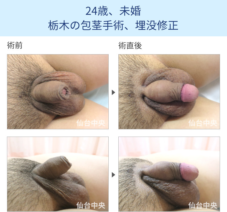 24歳、未婚。栃木の包茎手術、埋没修正