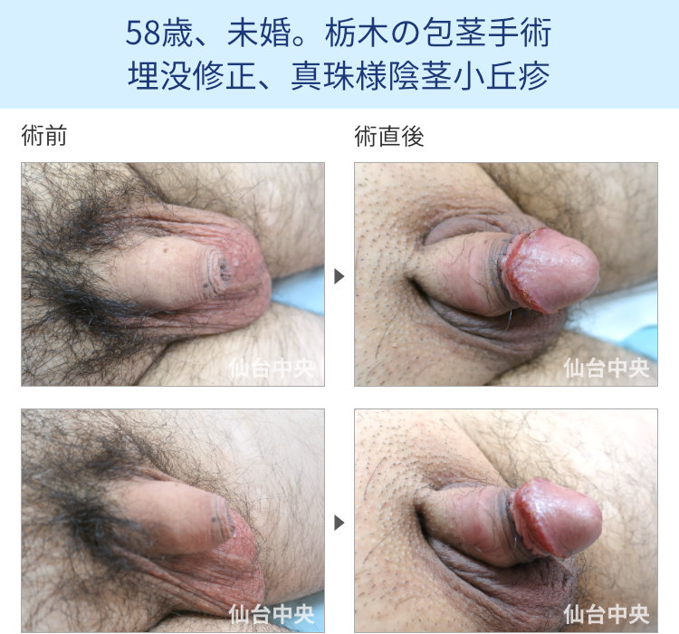 58歳、未婚。栃木の包茎手術、埋没修正、真珠様陰茎小丘疹
